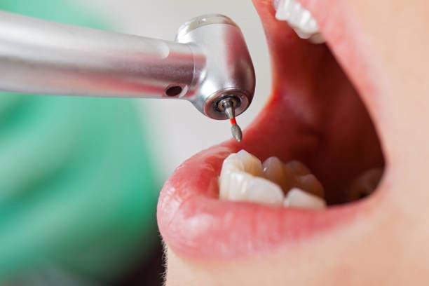 Best Emergency Tooth Extraction in Estill Springs, TN